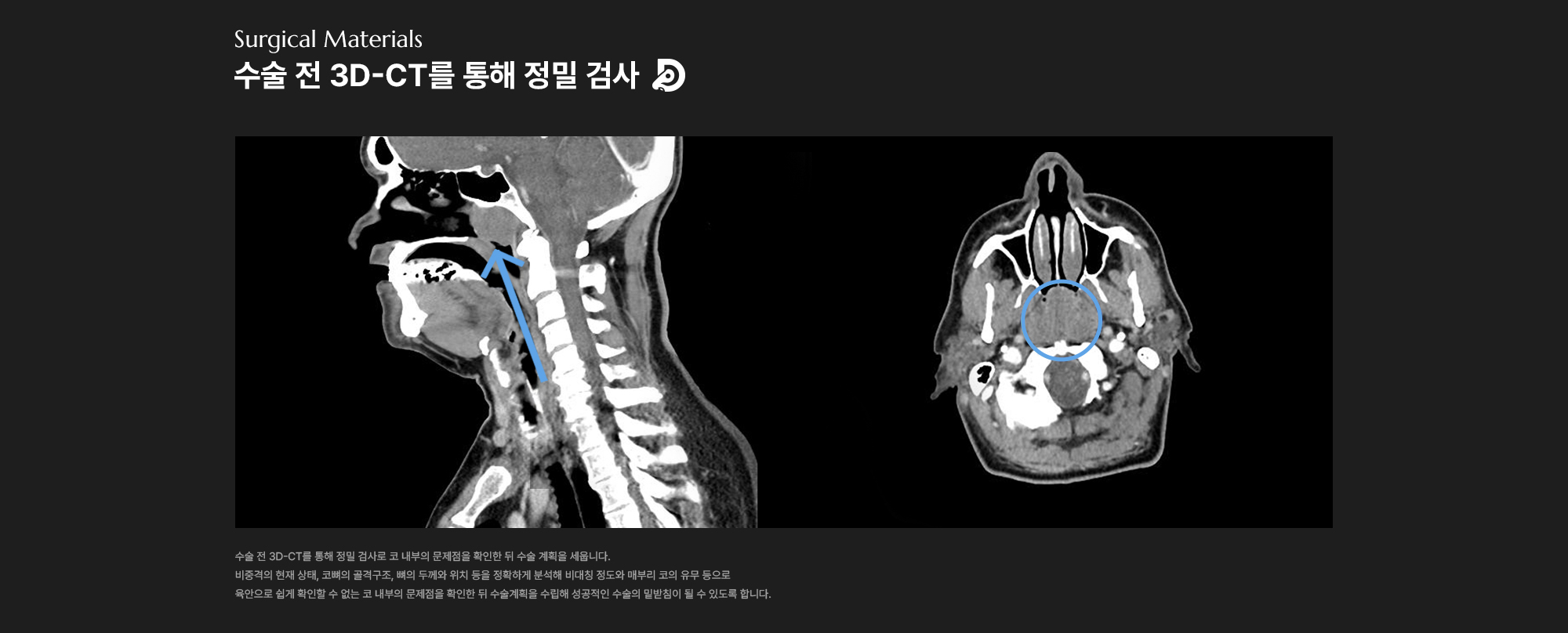 코골이수술